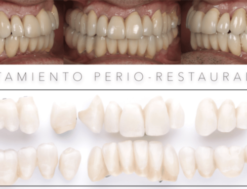 Antes y después de un caso periodontal avanzado