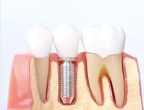 Partes de un implante dental