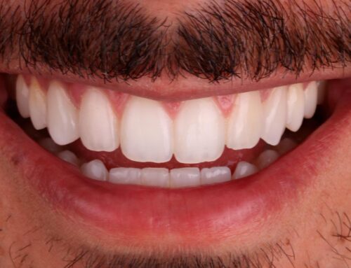¿Por qué se oscurecen los dientes, qué solución hay y qué precio tiene?