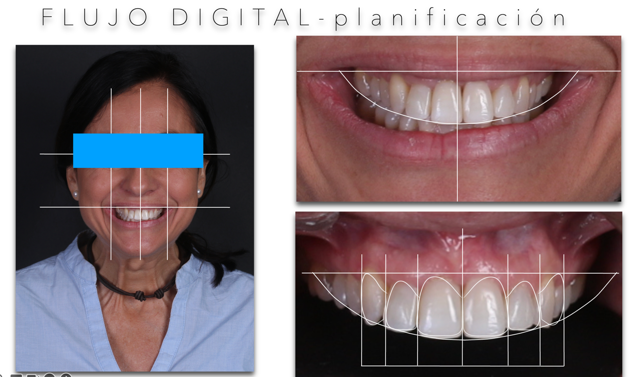 carillas dentales ejemplos